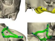 La planificació digital impulsa els implants subperiòstics com a alternativa en pacients amb pèrdua extrema d’os