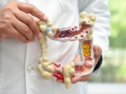 Experts subratllen la importància del cribratge en el càncer de còlon